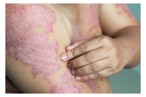 psoriasis